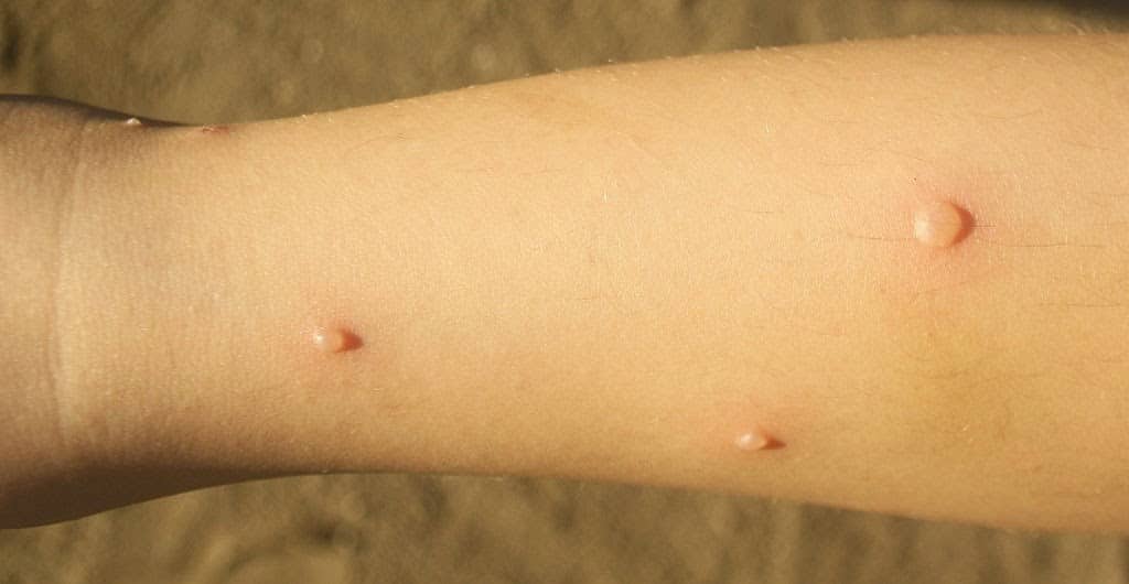 ¿Qué sabes de la varicela?