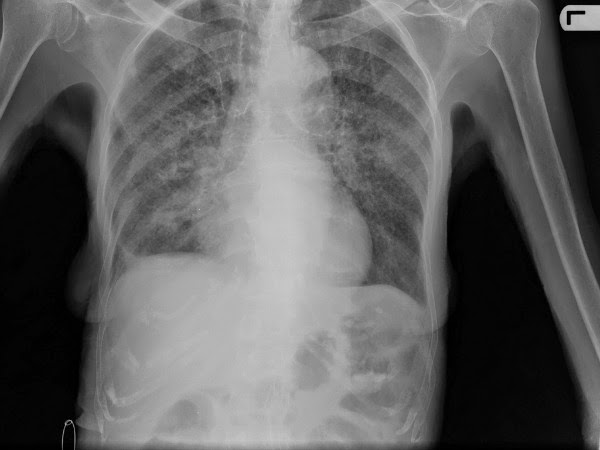 Cáncer de colon con metástasis pulmonar