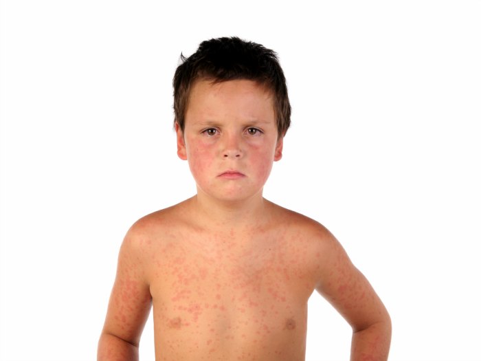 ¿Cómo saber si mi hijo tiene sarampión?