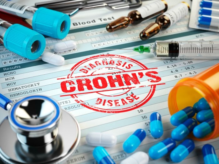 Qué es la enfermedad de Crohn